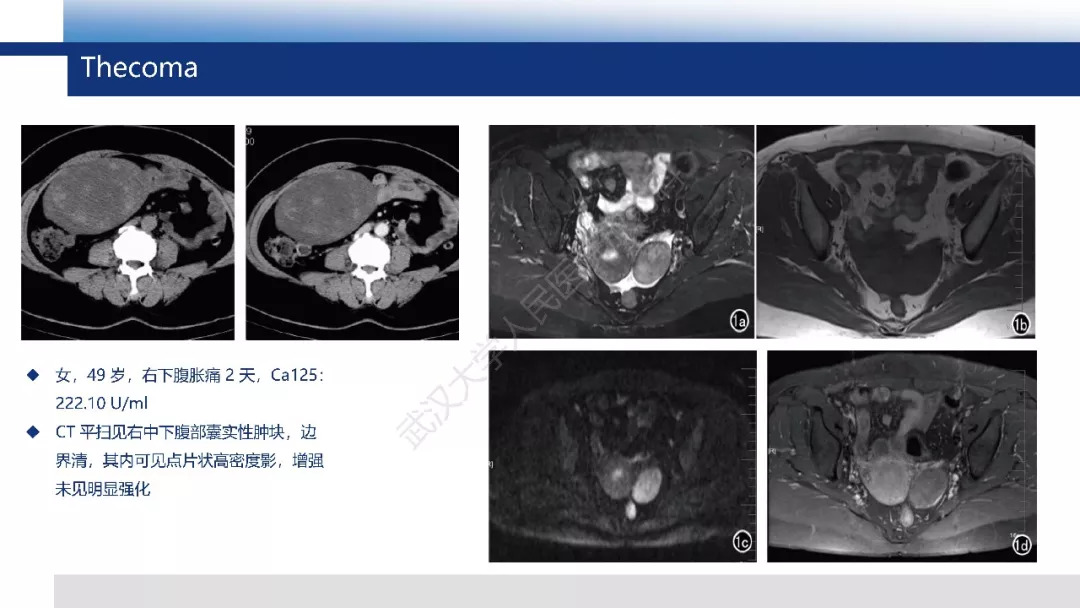 【PPT】卵巢无性细胞瘤影像诊断
