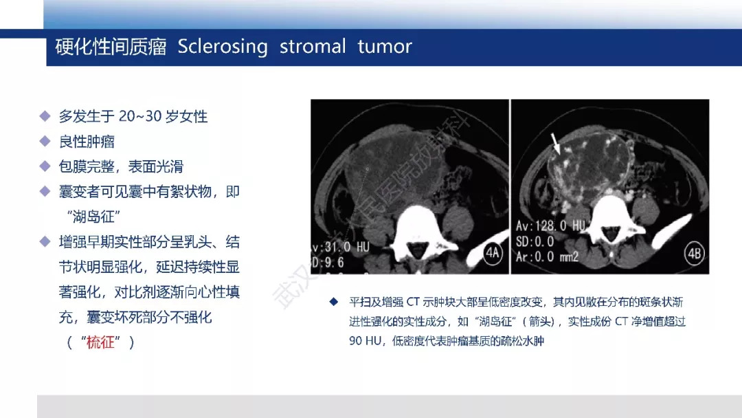【PPT】卵巢无性细胞瘤影像诊断
