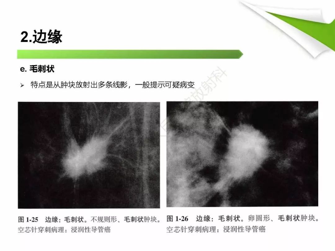 【PPT】乳腺X线影像表现与术语规范