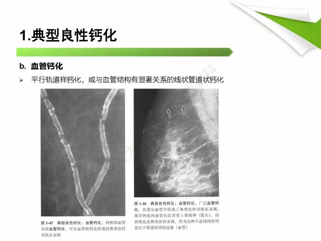 【PPT】乳腺X线影像表现与术语规范