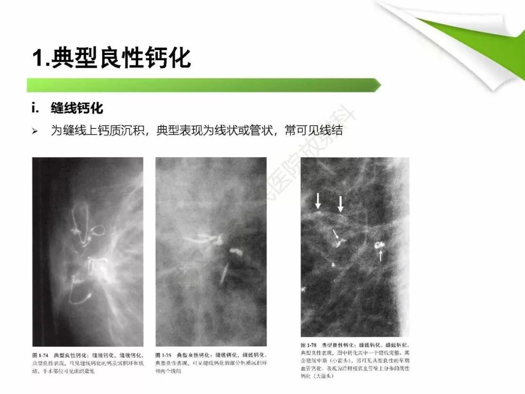 【PPT】乳腺X线影像表现与术语规范