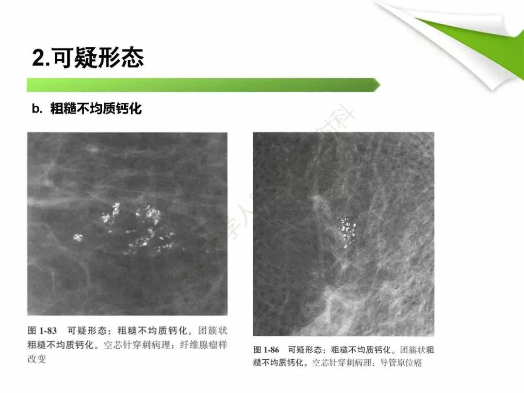 【PPT】乳腺X线影像表现与术语规范