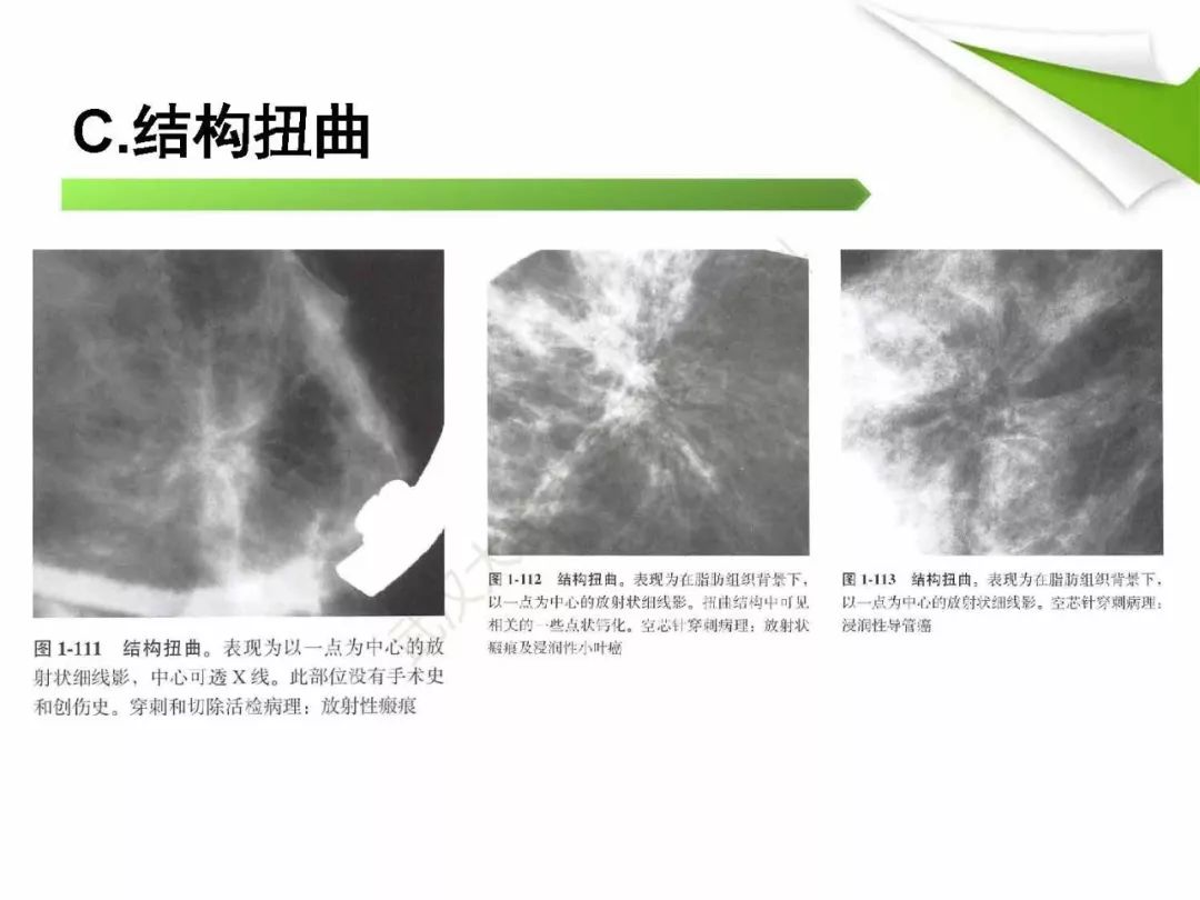 【PPT】乳腺X线影像表现与术语规范