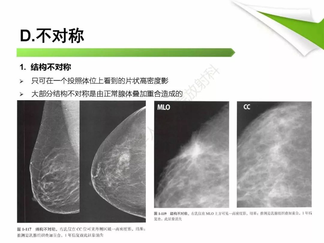 【PPT】乳腺X线影像表现与术语规范