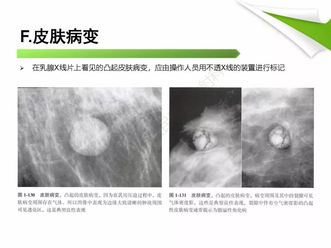 【PPT】乳腺X线影像表现与术语规范