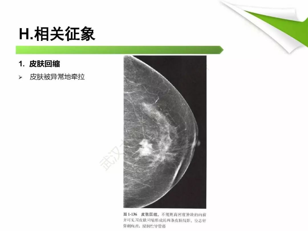 【PPT】乳腺X线影像表现与术语规范