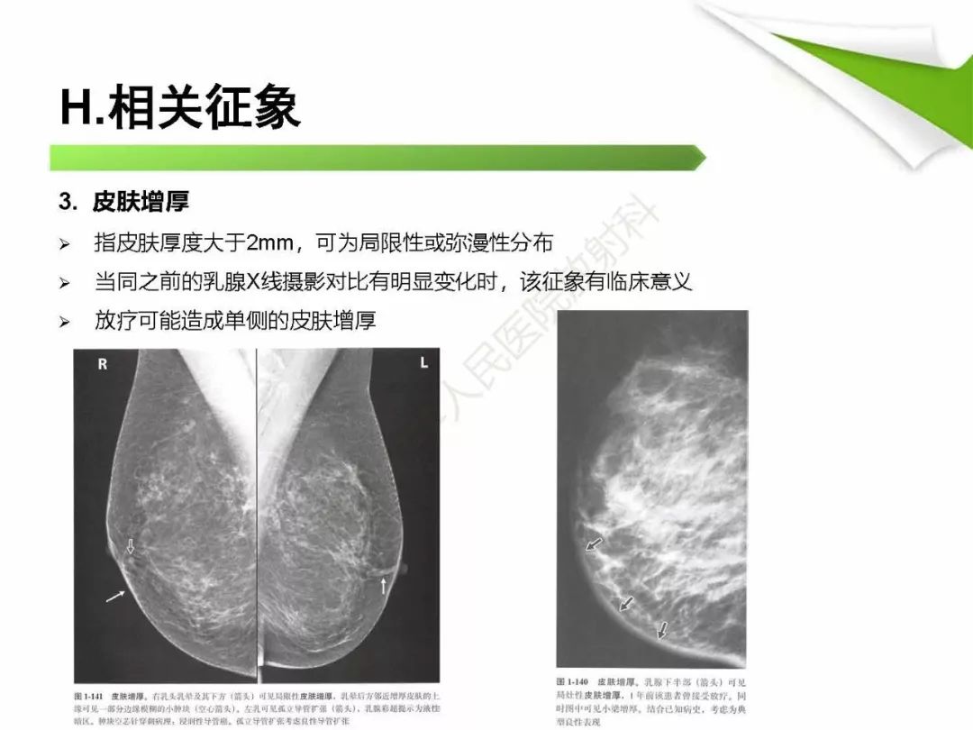 【PPT】乳腺X线影像表现与术语规范