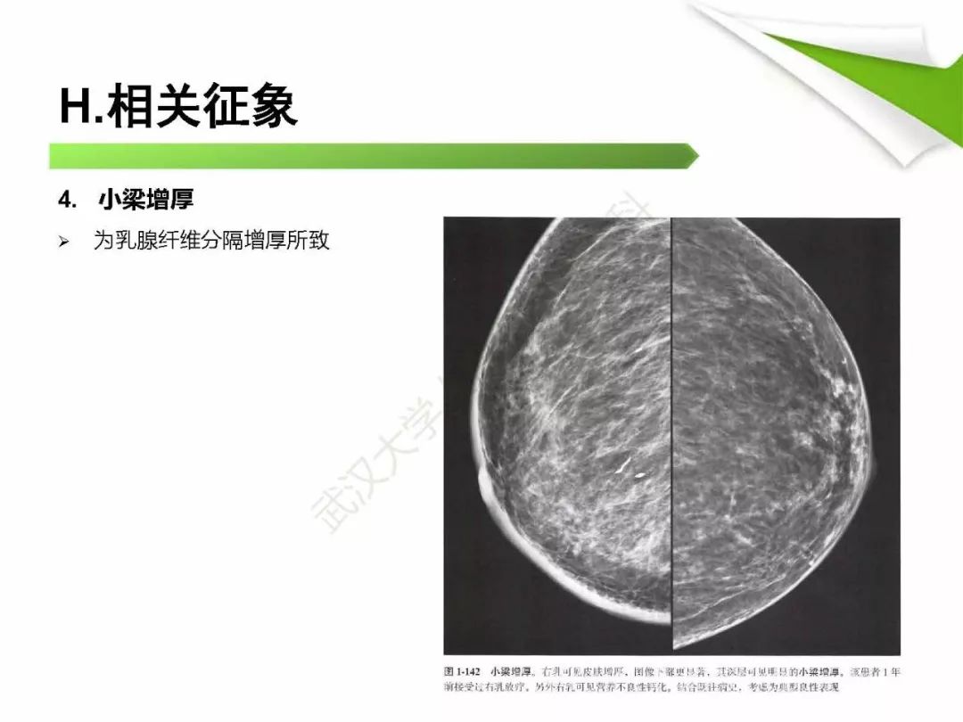 【PPT】乳腺X线影像表现与术语规范