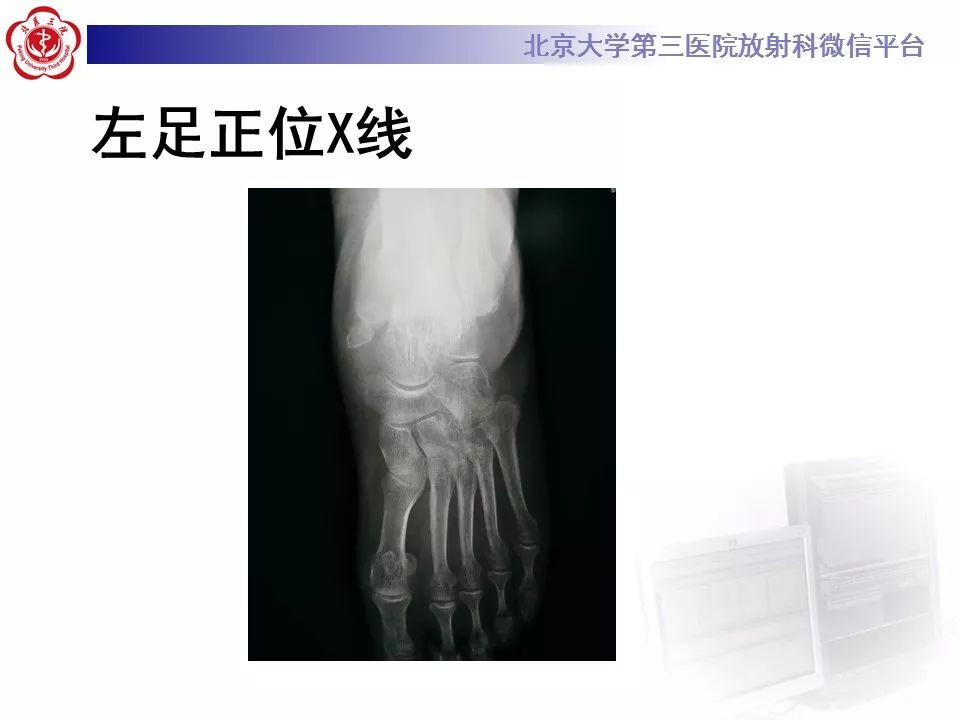 【病例】足副舟骨损伤1例X线CT及MR