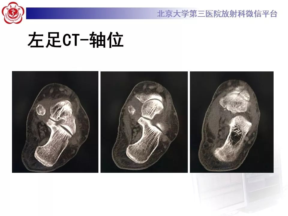 【病例】足副舟骨损伤1例X线CT及MR