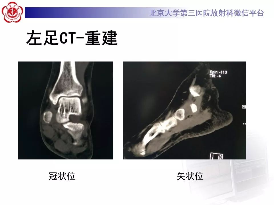 【病例】足副舟骨损伤1例X线CT及MR