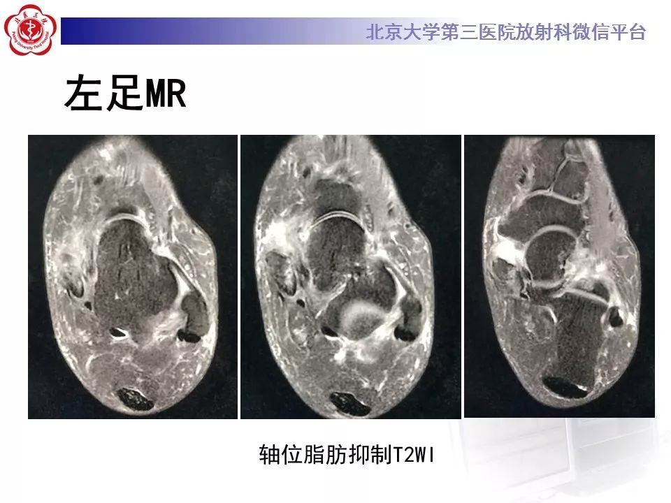 【病例】足副舟骨损伤1例X线CT及MR