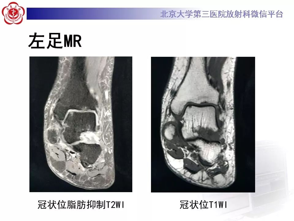 【病例】足副舟骨损伤1例X线CT及MR