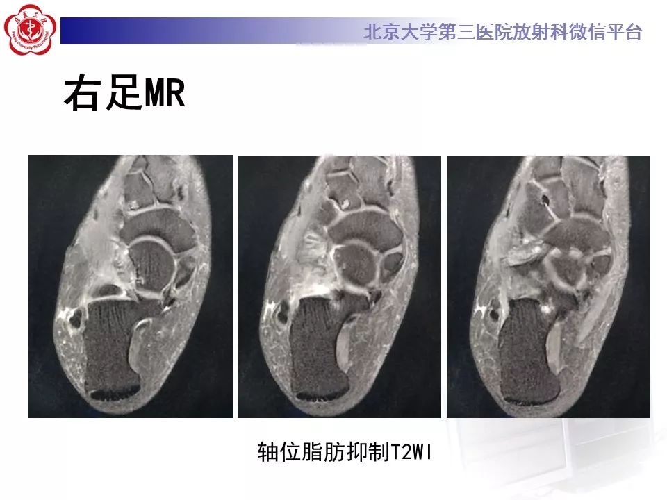 【病例】足副舟骨损伤1例X线CT及MR