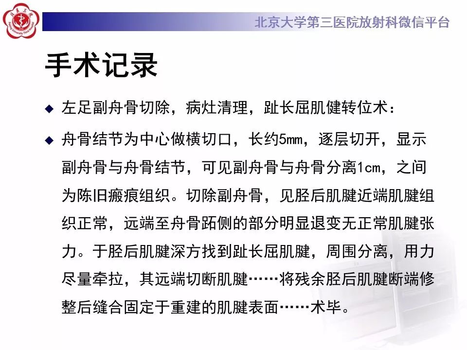 【病例】足副舟骨损伤1例X线CT及MR