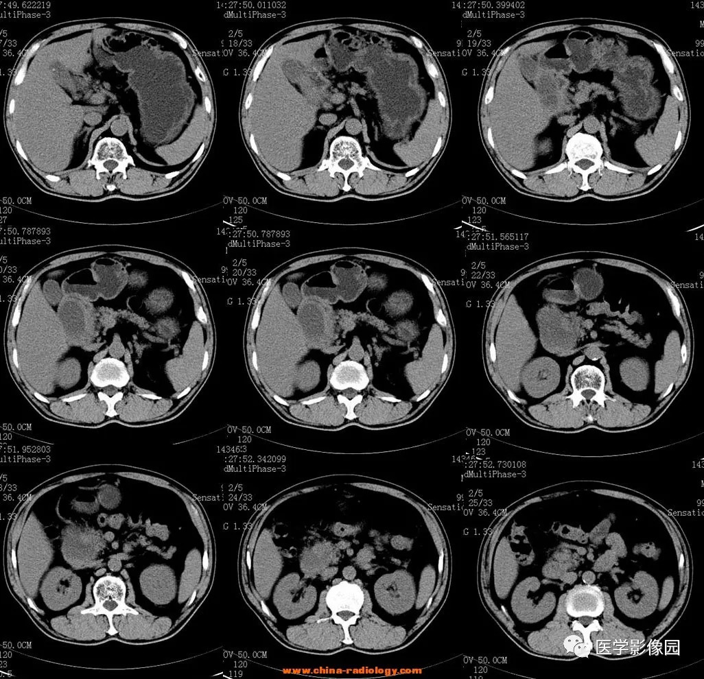 【病例】十二指肠肌层炎症并发囊性变1例CT 【病例】十二指肠肌层炎症并发囊性变1例CT