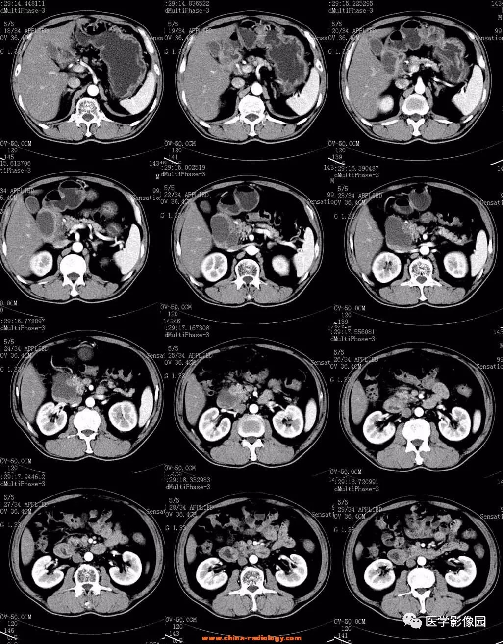 【病例】十二指肠肌层炎症并发囊性变1例CT 【病例】十二指肠肌层炎症并发囊性变1例CT