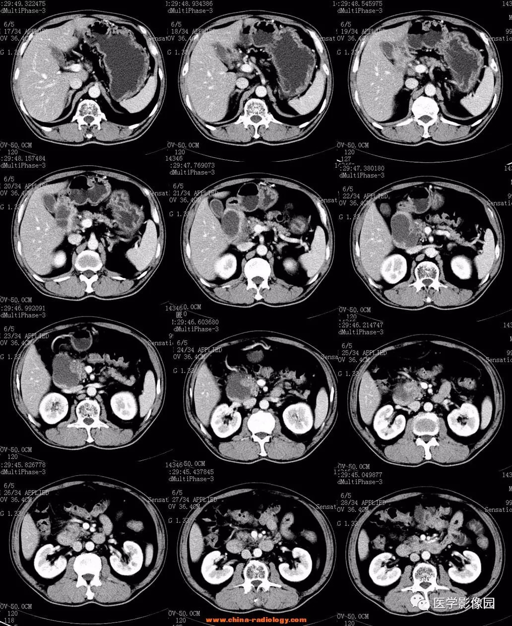 【病例】十二指肠肌层炎症并发囊性变1例CT 【病例】十二指肠肌层炎症并发囊性变1例CT