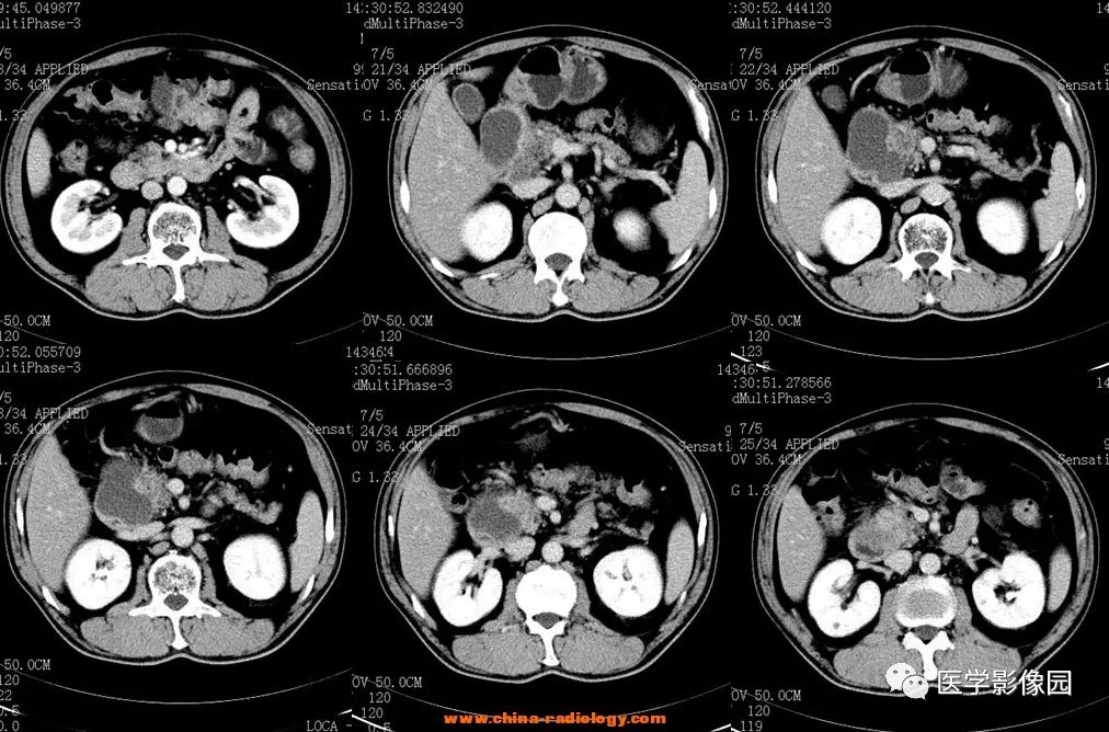 【病例】十二指肠肌层炎症并发囊性变1例CT 【病例】十二指肠肌层炎症并发囊性变1例CT