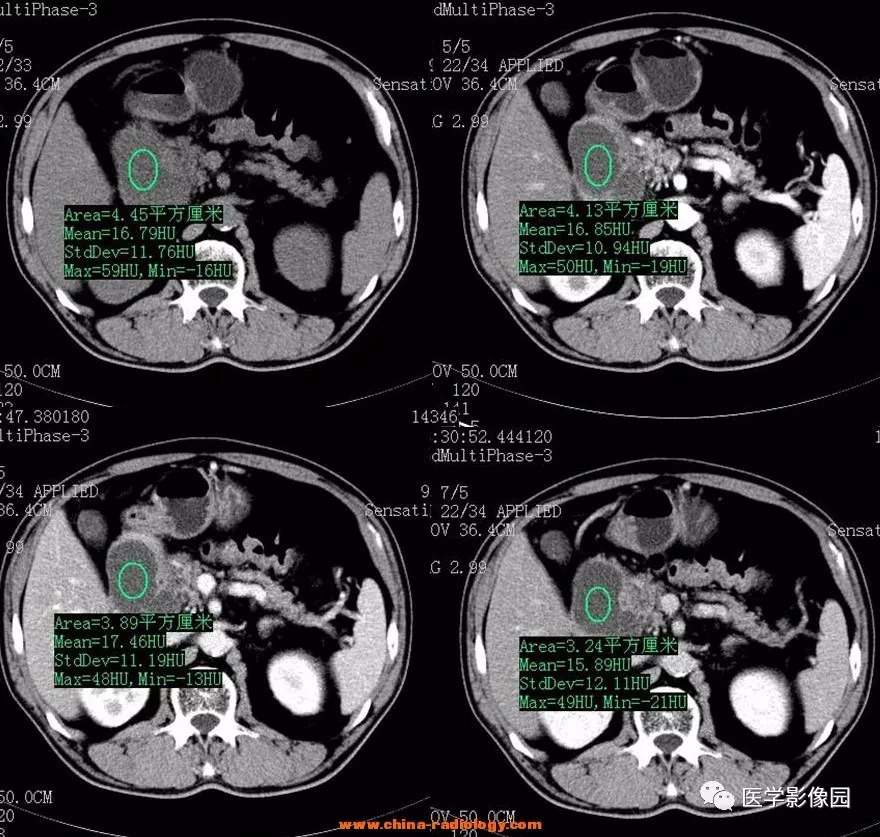 【病例】十二指肠肌层炎症并发囊性变1例CT 【病例】十二指肠肌层炎症并发囊性变1例CT