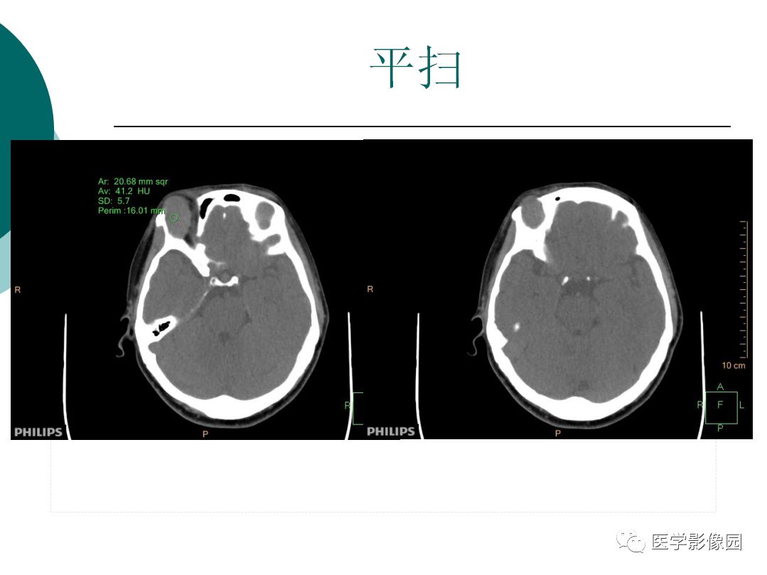 【病例】眼眶炎性假瘤1例CT影像表现