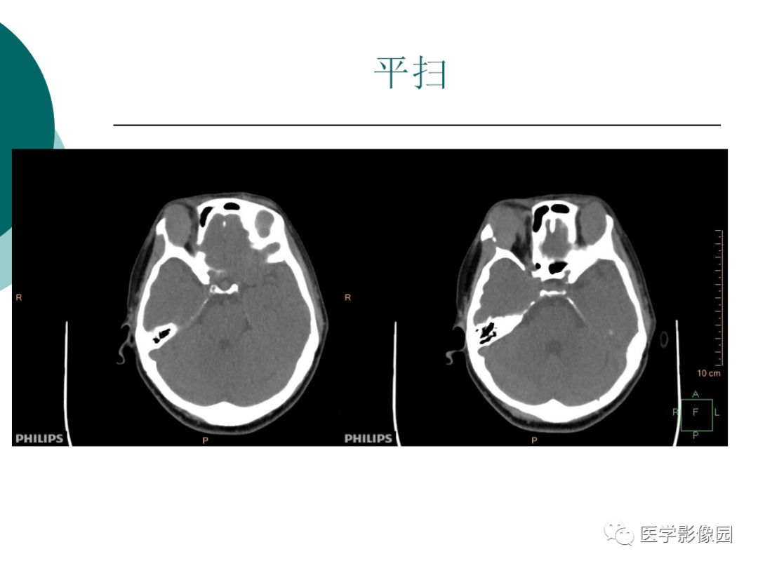 【病例】眼眶炎性假瘤1例CT影像表现