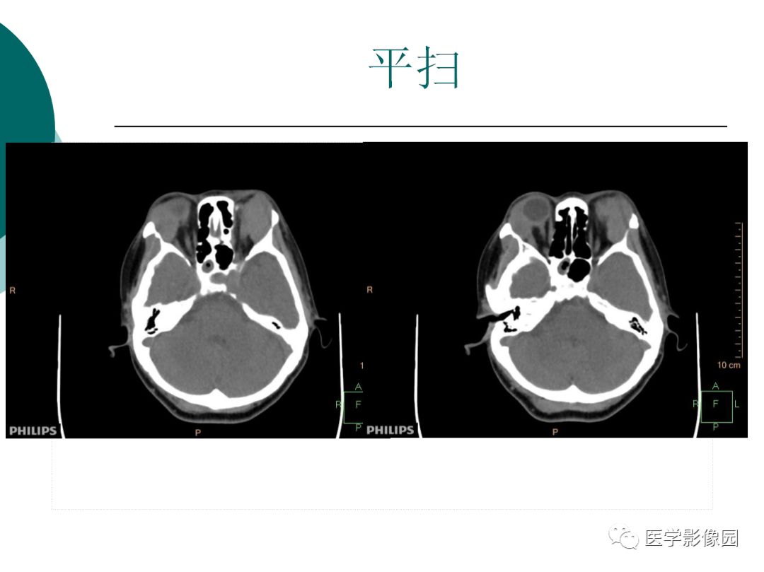 【病例】眼眶炎性假瘤1例CT影像表现
