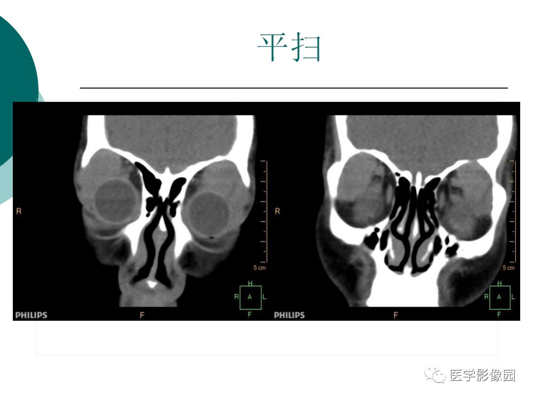 【病例】眼眶炎性假瘤1例CT影像表现