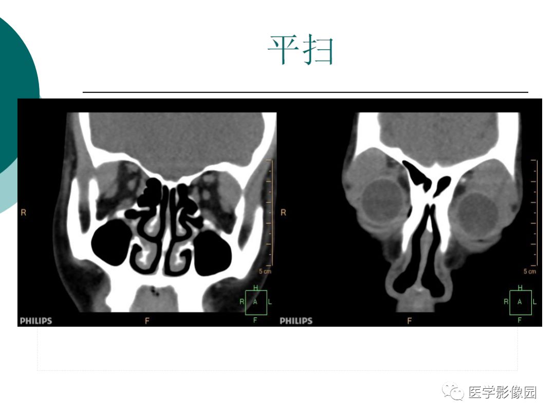 【病例】眼眶炎性假瘤1例CT影像表现