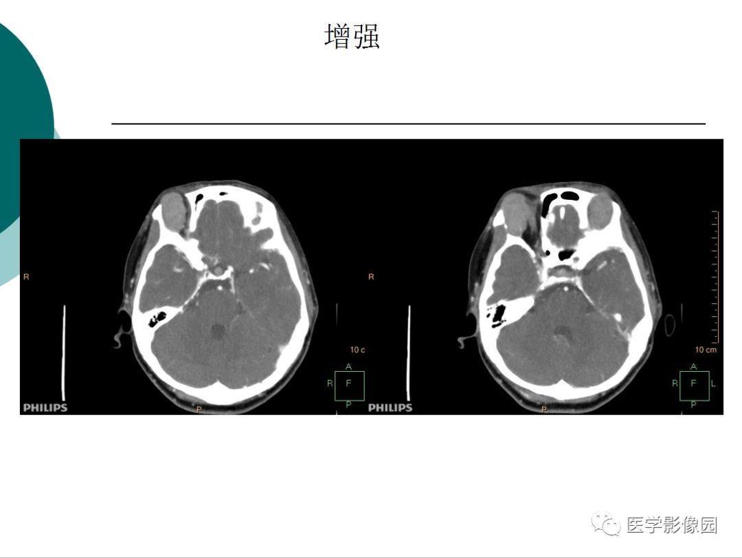 【病例】眼眶炎性假瘤1例CT影像表现