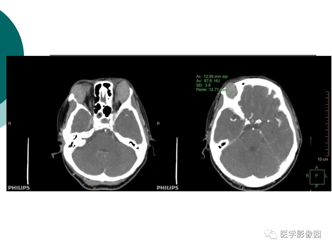 【病例】眼眶炎性假瘤1例CT影像表现