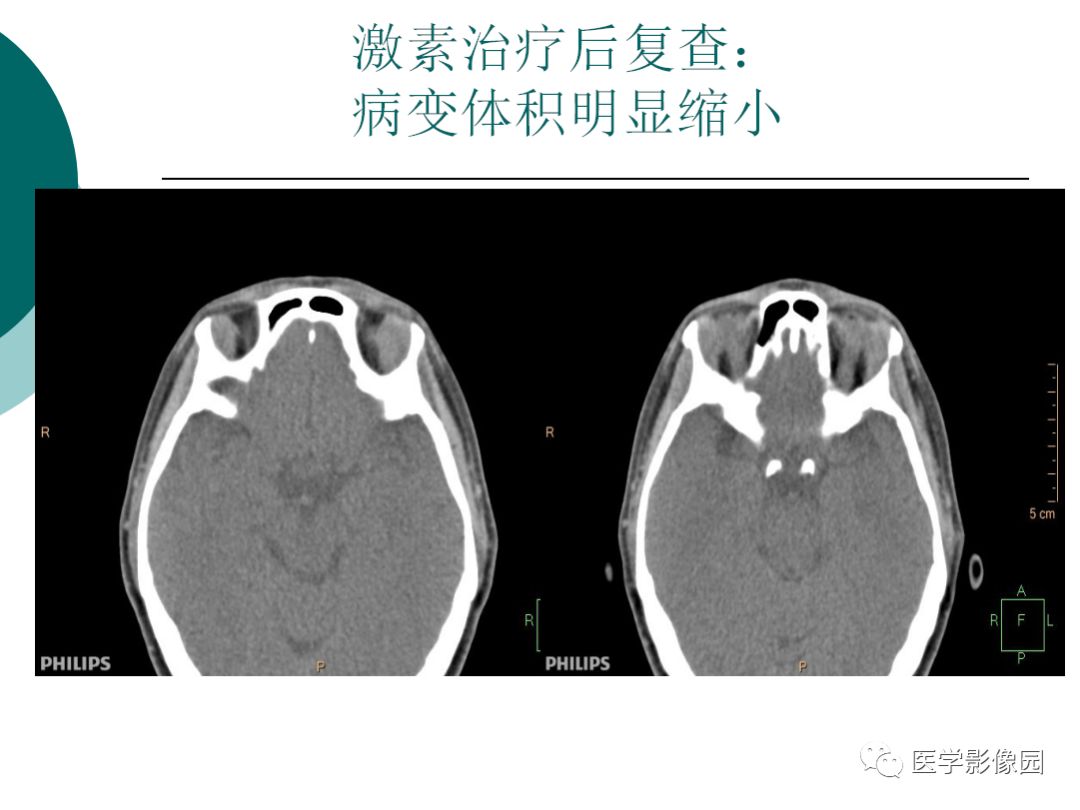 【病例】眼眶炎性假瘤1例CT影像表现