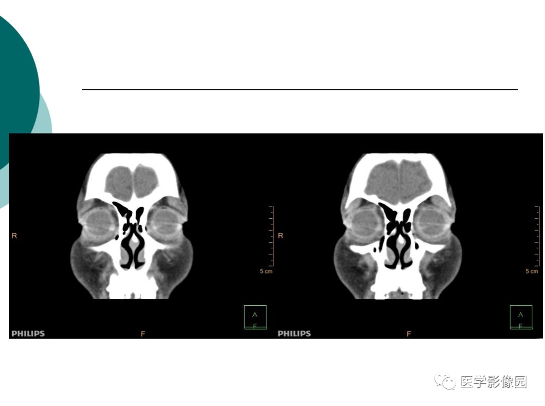 【病例】眼眶炎性假瘤1例CT影像表现