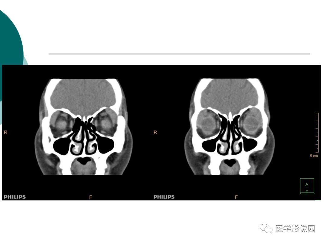 【病例】眼眶炎性假瘤1例CT影像表现