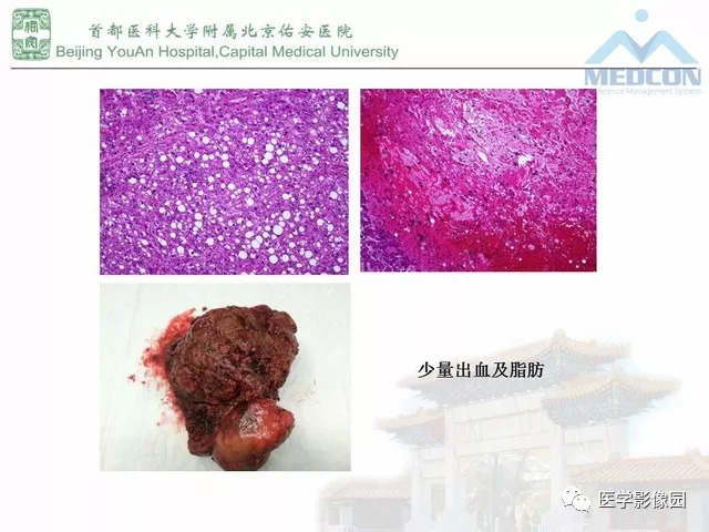 【PPT】肝脏少见良性肿瘤及肿瘤样病变影像诊断