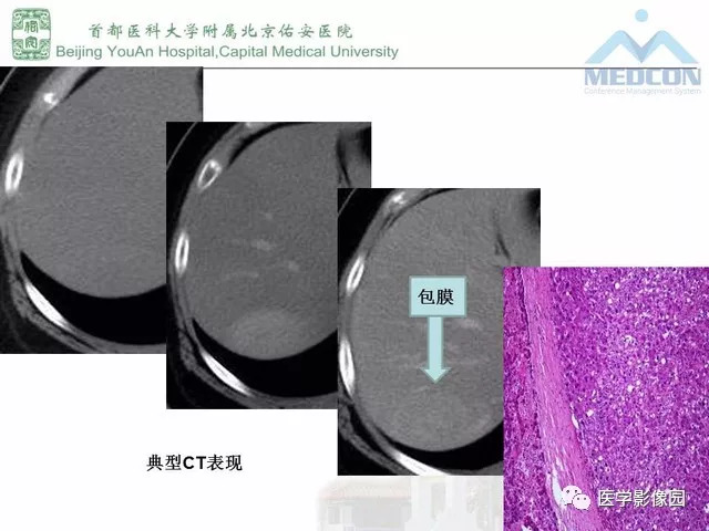 【PPT】肝脏少见良性肿瘤及肿瘤样病变影像诊断