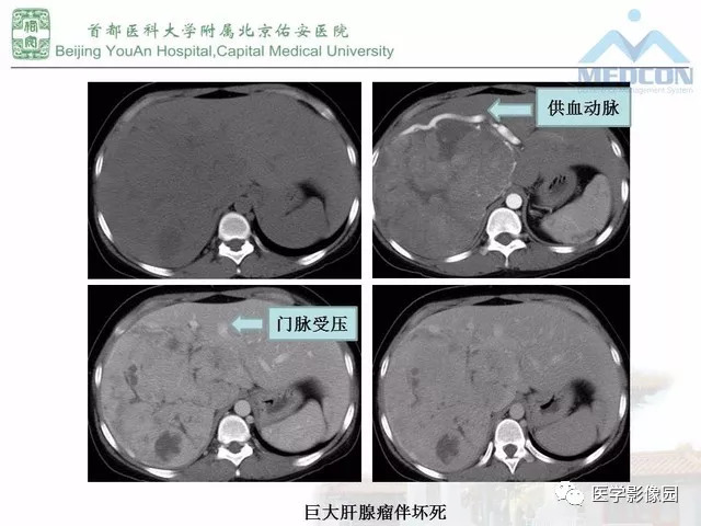 【PPT】肝脏少见良性肿瘤及肿瘤样病变影像诊断