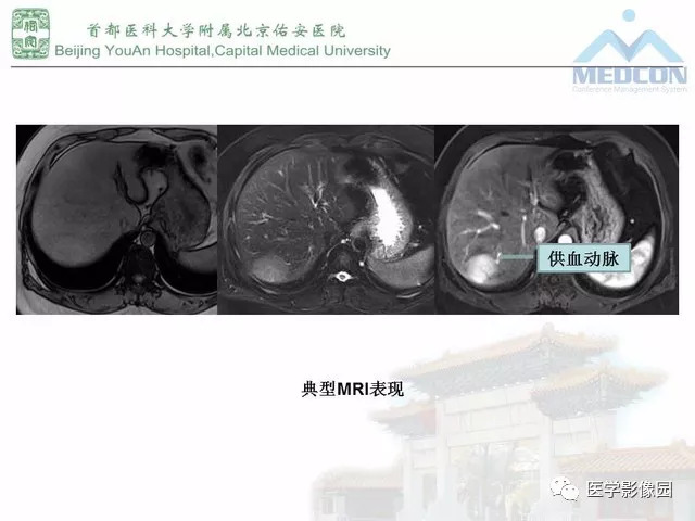 【PPT】肝脏少见良性肿瘤及肿瘤样病变影像诊断