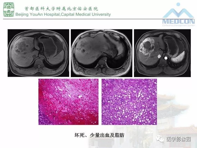 【PPT】肝脏少见良性肿瘤及肿瘤样病变影像诊断