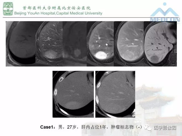 【PPT】肝脏少见良性肿瘤及肿瘤样病变影像诊断