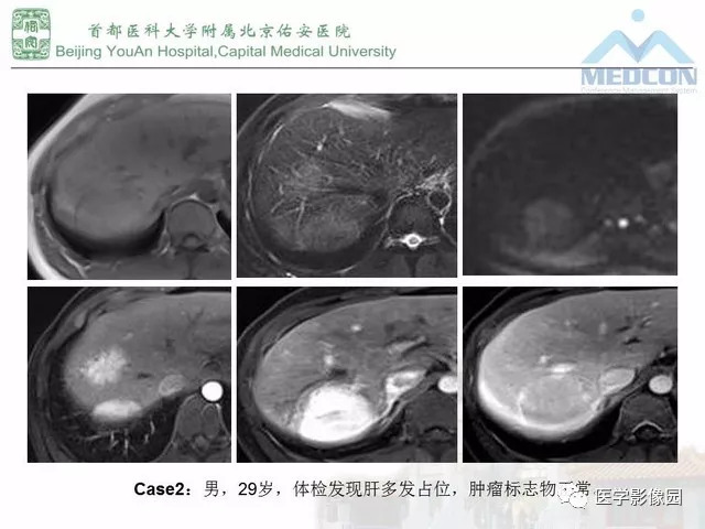 【PPT】肝脏少见良性肿瘤及肿瘤样病变影像诊断