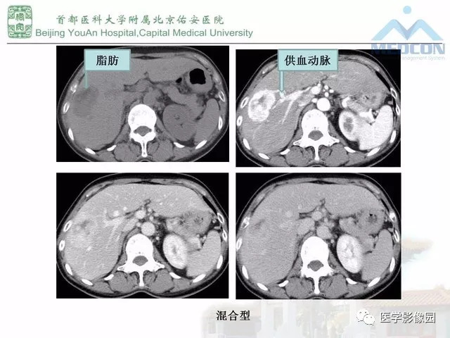 【PPT】肝脏少见良性肿瘤及肿瘤样病变影像诊断