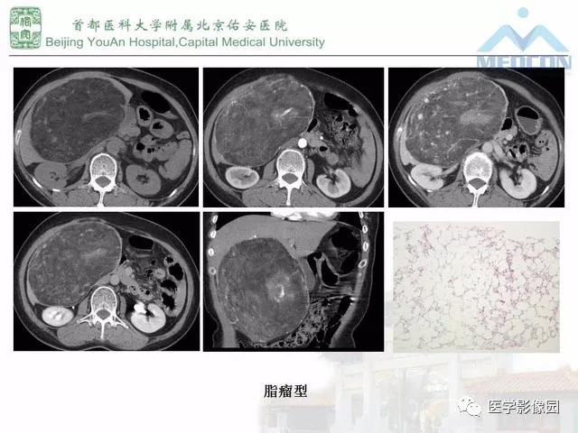 【PPT】肝脏少见良性肿瘤及肿瘤样病变影像诊断