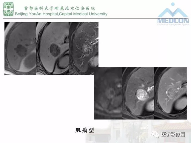 【PPT】肝脏少见良性肿瘤及肿瘤样病变影像诊断