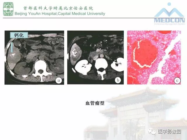 【PPT】肝脏少见良性肿瘤及肿瘤样病变影像诊断