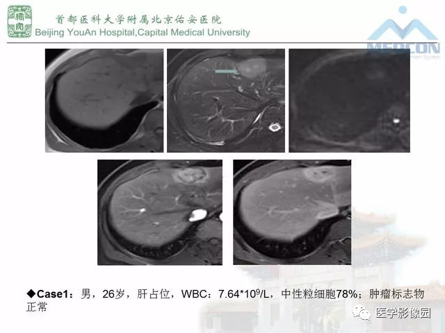 【PPT】肝脏少见良性肿瘤及肿瘤样病变影像诊断