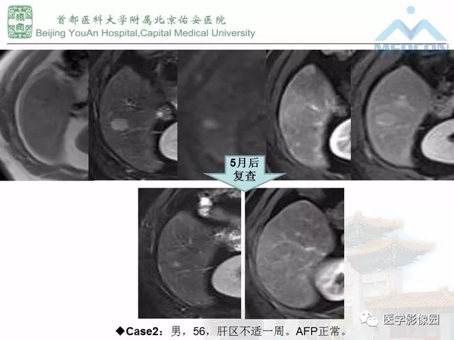 【PPT】肝脏少见良性肿瘤及肿瘤样病变影像诊断
