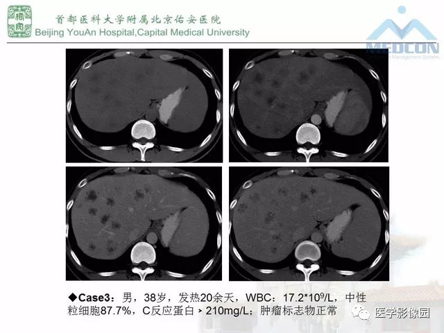 【PPT】肝脏少见良性肿瘤及肿瘤样病变影像诊断