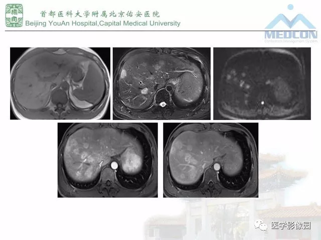 【PPT】肝脏少见良性肿瘤及肿瘤样病变影像诊断