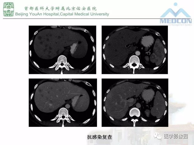 【PPT】肝脏少见良性肿瘤及肿瘤样病变影像诊断